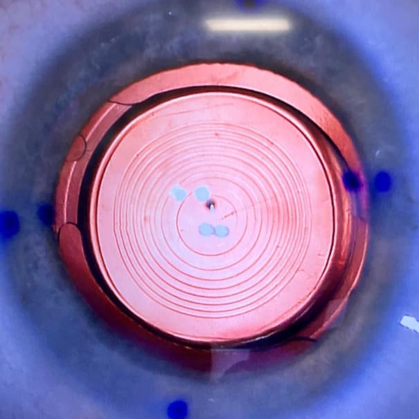 Trifocal